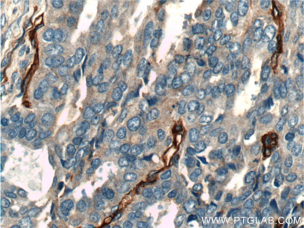 IHC staining of human ovary tumor using 17564-1-AP