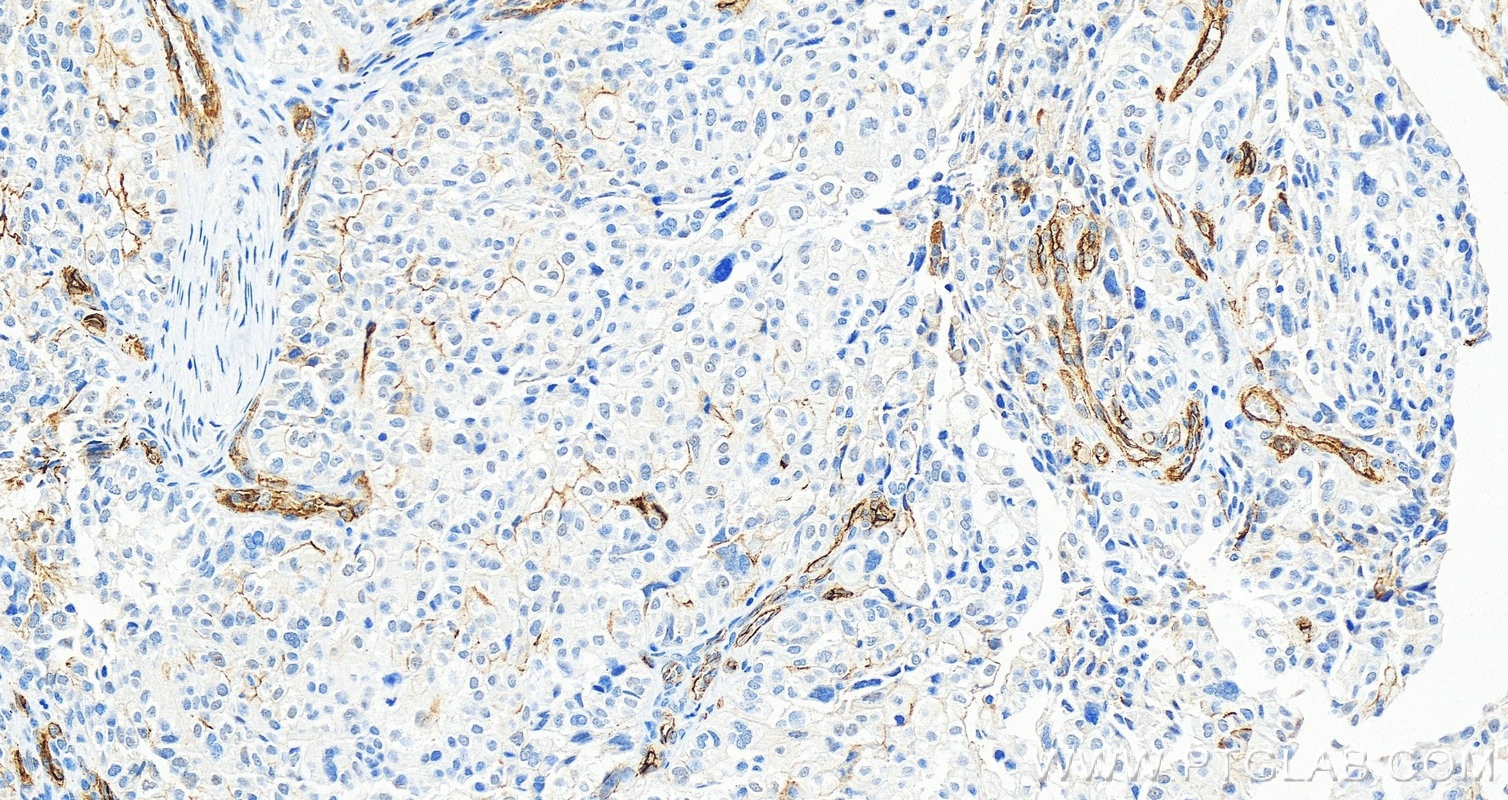 Immunohistochemistry (IHC) staining of human ovary cancer tissue using CD146/MCAM Polyclonal antibody (17564-1-AP)