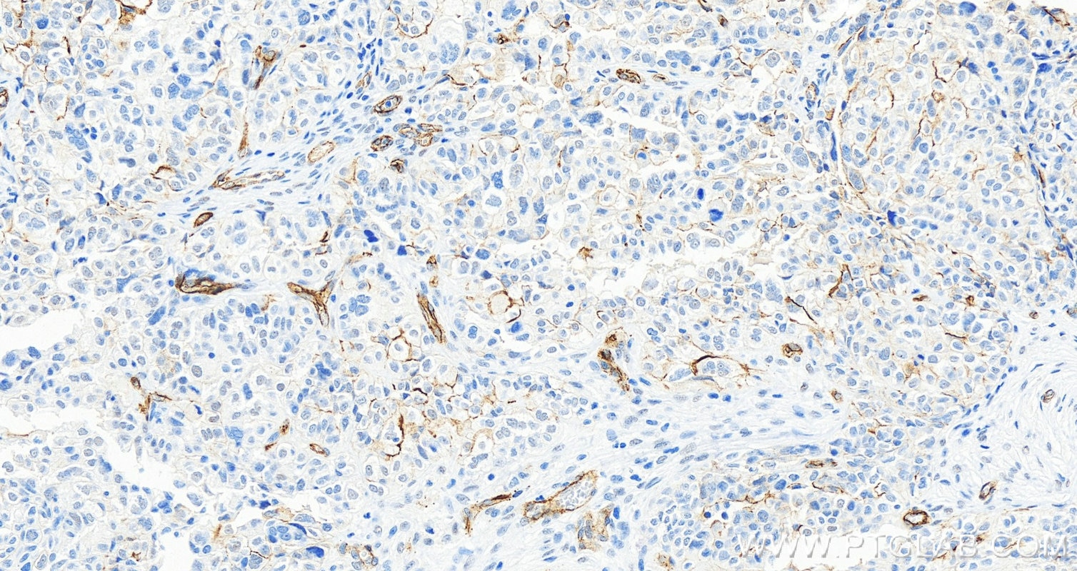 Immunohistochemistry (IHC) staining of human ovary cancer tissue using CD146/MCAM Polyclonal antibody (17564-1-AP)