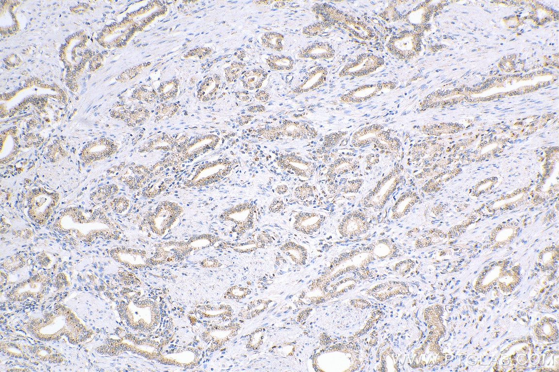 Immunohistochemistry (IHC) staining of human prostate cancer tissue using MCC Polyclonal antibody (11525-1-AP)