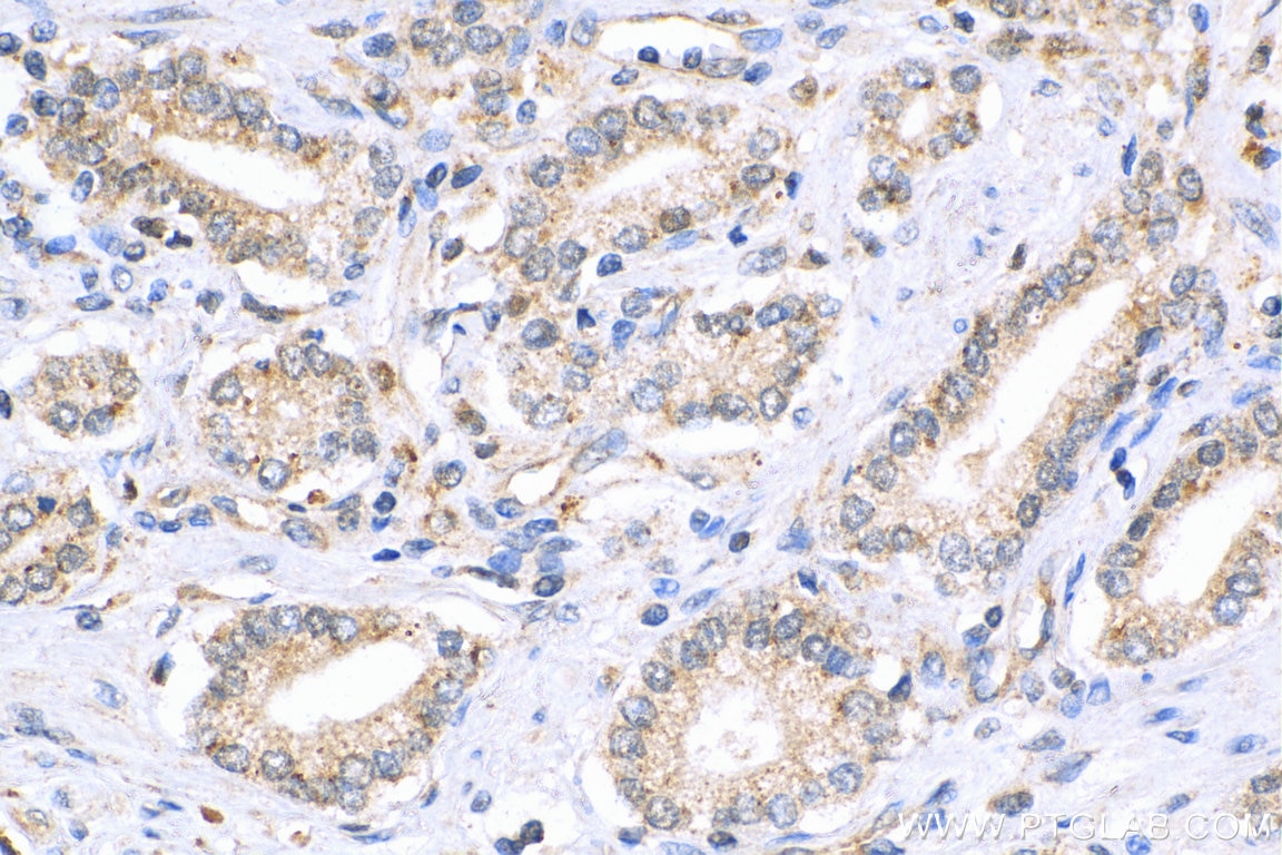 Immunohistochemistry (IHC) staining of human prostate cancer tissue using MCC Polyclonal antibody (11525-1-AP)