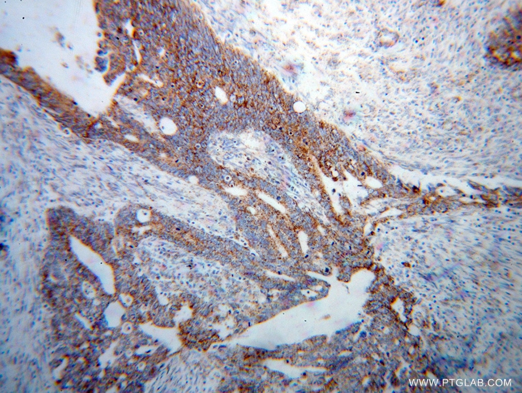 Immunohistochemistry (IHC) staining of human liver cancer tissue using MCCC1 Polyclonal antibody (14861-1-AP)