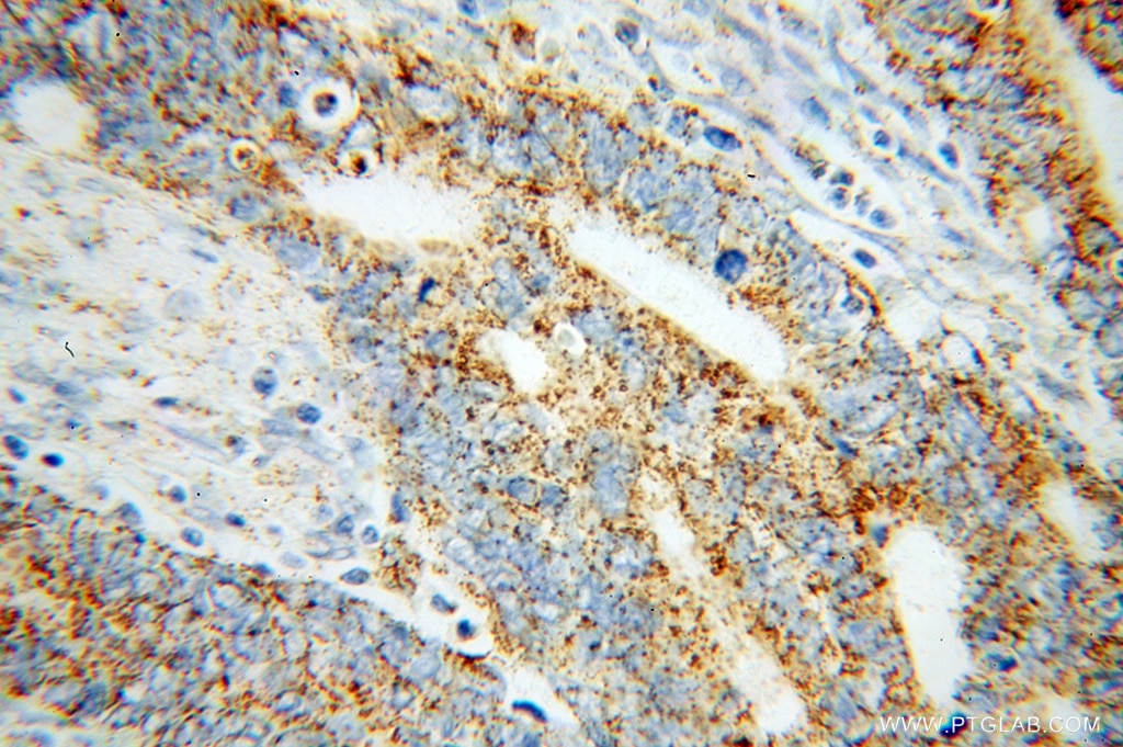 Immunohistochemistry (IHC) staining of human liver cancer tissue using MCCC1 Polyclonal antibody (14861-1-AP)