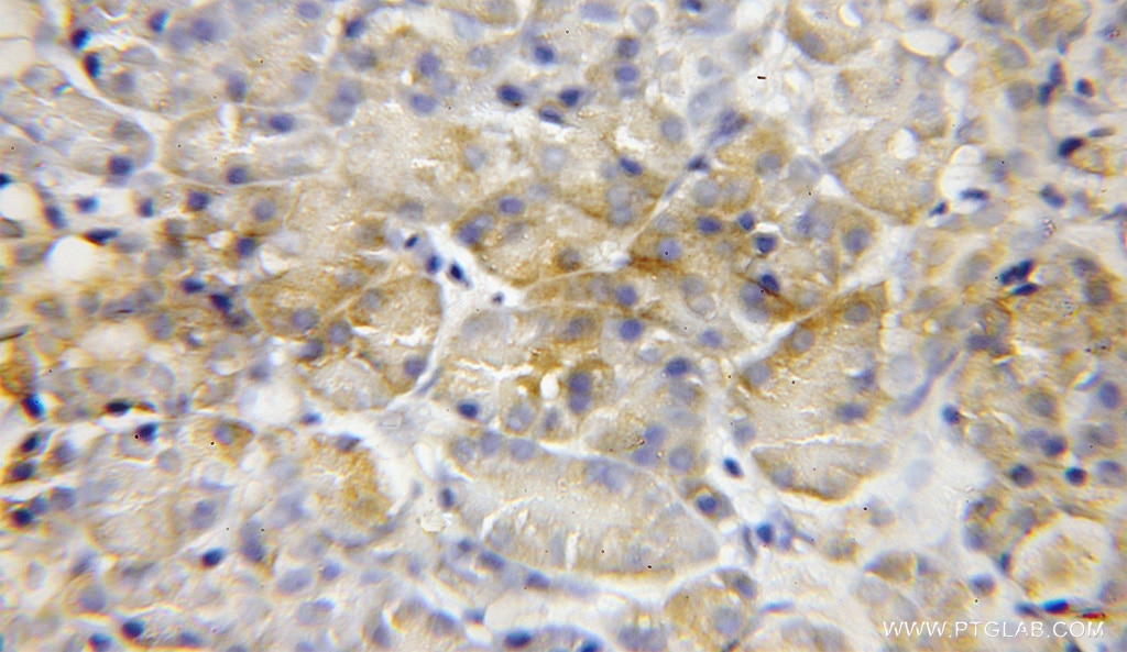 Immunohistochemistry (IHC) staining of human pancreas cancer tissue using MCCC2 Polyclonal antibody (12117-1-AP)