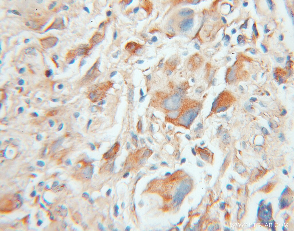 Immunohistochemistry (IHC) staining of human gliomas tissue using MCF2L Polyclonal antibody (11659-1-AP)