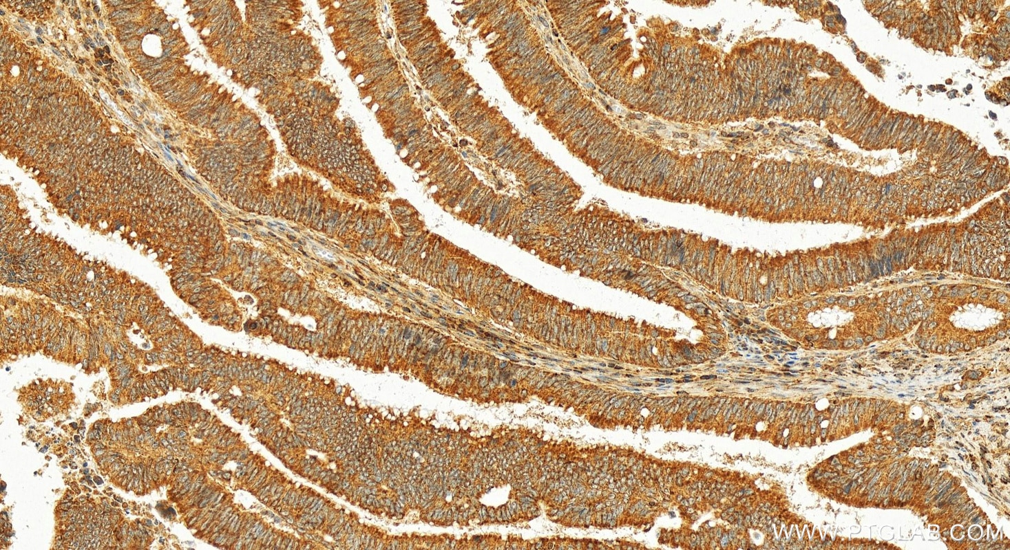 Immunohistochemical analysis of paraffin-embedded human colon cancer slide using 16225-1-AP (MCL1 antibody) at dilution of 1:400 (under 20x lens). Heat mediated antigen retrieval with Tris-EDTA buffer (pH 9.0). Immunohistochemistry (IHC) staining of human colon cancer using MCL1 Polyclonal antibody (16225-1-AP)