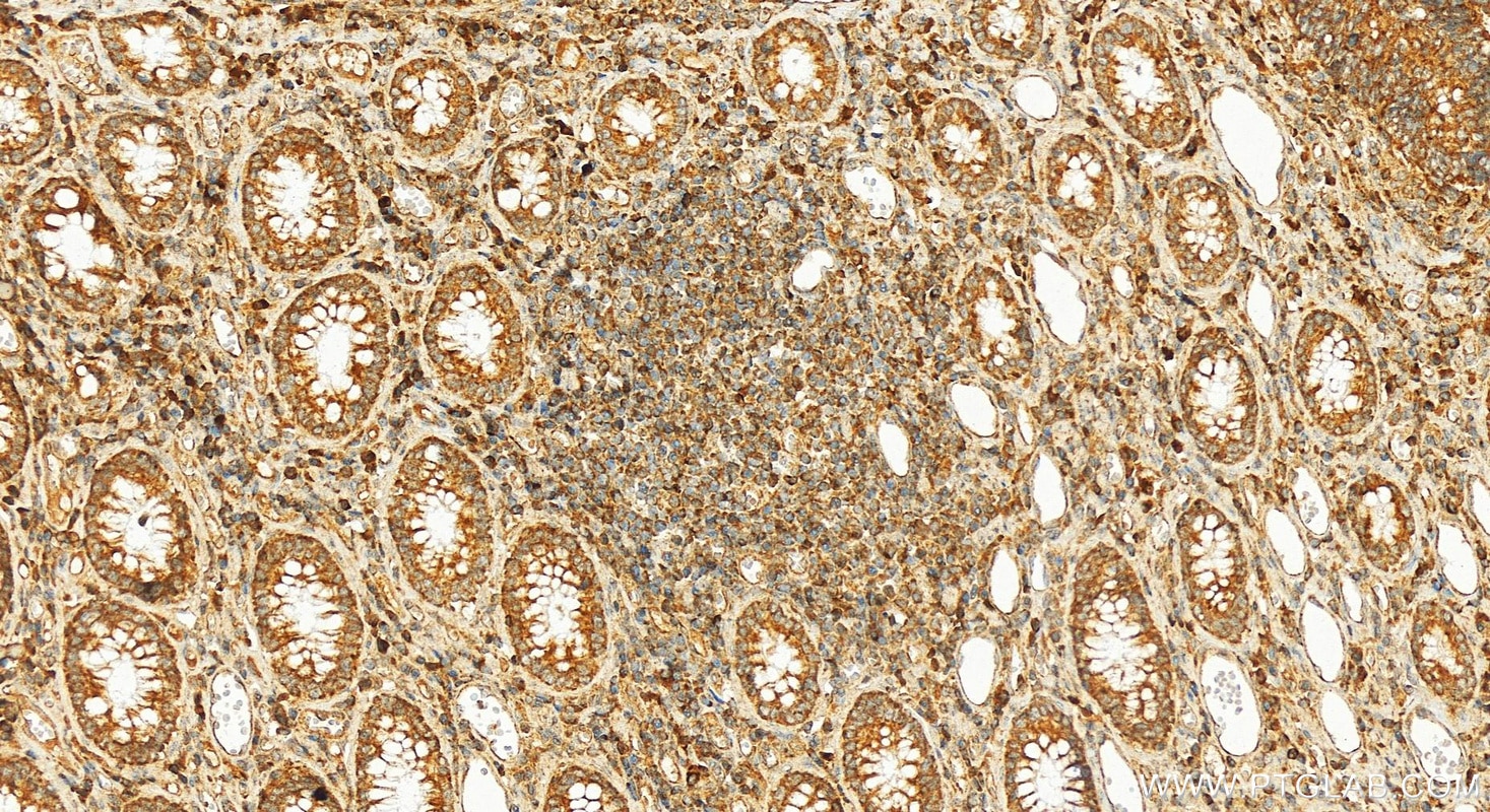 Immunohistochemical analysis of paraffin-embedded human colon cancer slide using 16225-1-AP (MCL1 antibody) at dilution of 1:400 (under 20x lens). Heat mediated antigen retrieval with Tris-EDTA buffer (pH 9.0). Immunohistochemistry (IHC) staining of human colon cancer using MCL1 Polyclonal antibody (16225-1-AP)