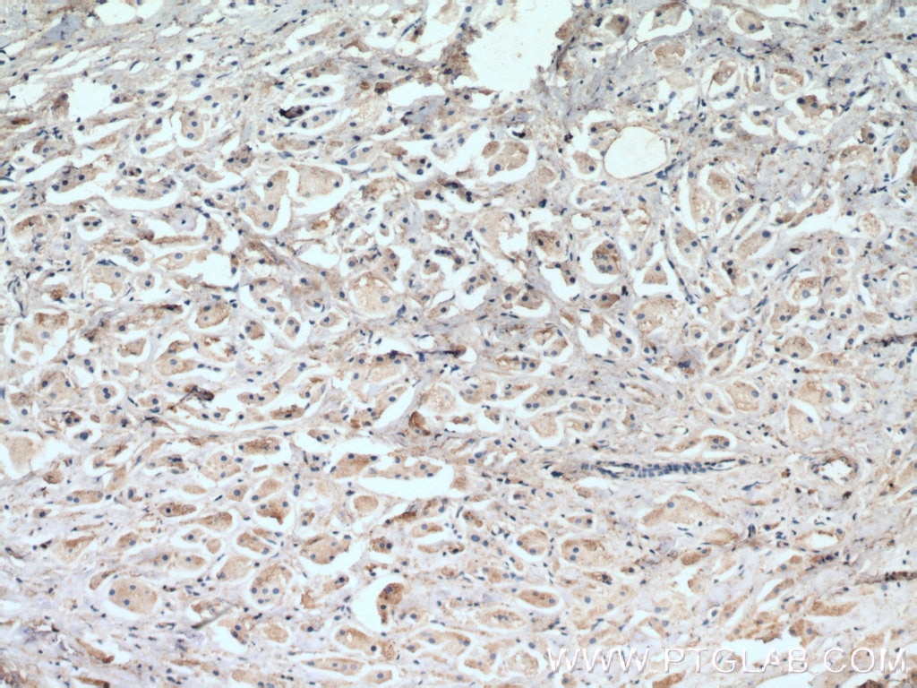 IHC staining of human breast cancer using 66026-1-Ig