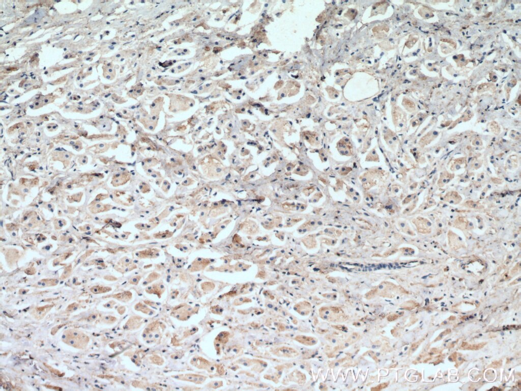 Immunohistochemistry (IHC) staining of human breast cancer tissue using MCL1 Monoclonal antibody (66026-1-Ig)