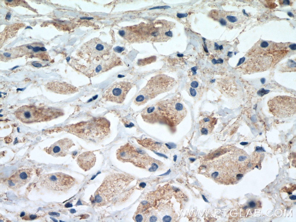 Immunohistochemistry (IHC) staining of human breast cancer tissue using MCL1 Monoclonal antibody (66026-1-Ig)