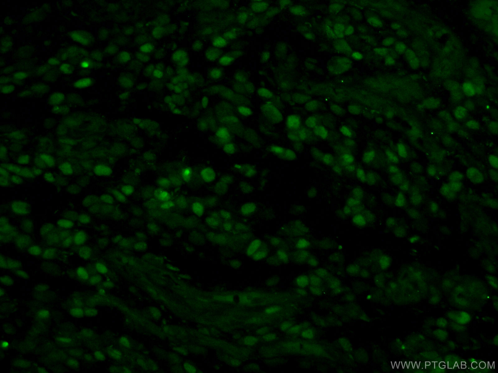 Immunofluorescence (IF) / fluorescent staining of human gliomas tissue using MCM2 Polyclonal antibody (10513-1-AP)