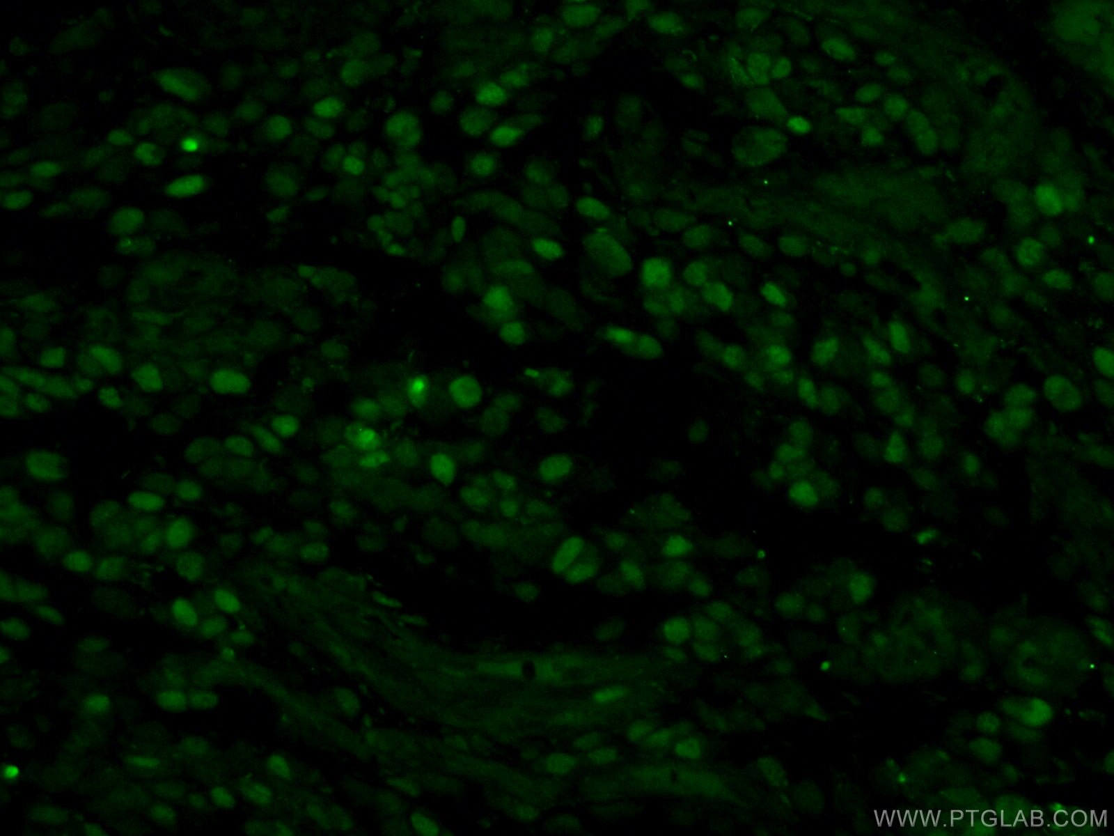 IF Staining of human gliomas using 10513-1-AP