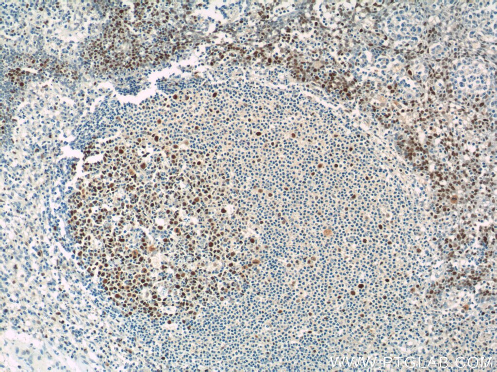 Immunohistochemistry (IHC) staining of human tonsillitis tissue using MCM2 Polyclonal antibody (10513-1-AP)