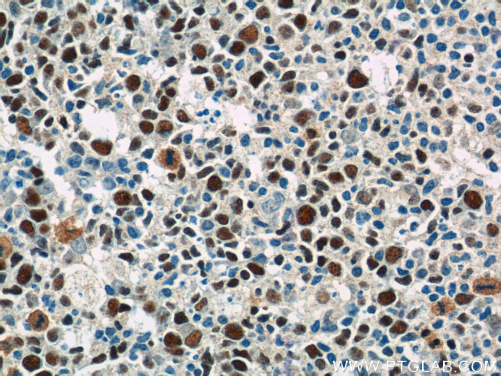 Immunohistochemistry (IHC) staining of human tonsillitis tissue using MCM2 Polyclonal antibody (10513-1-AP)