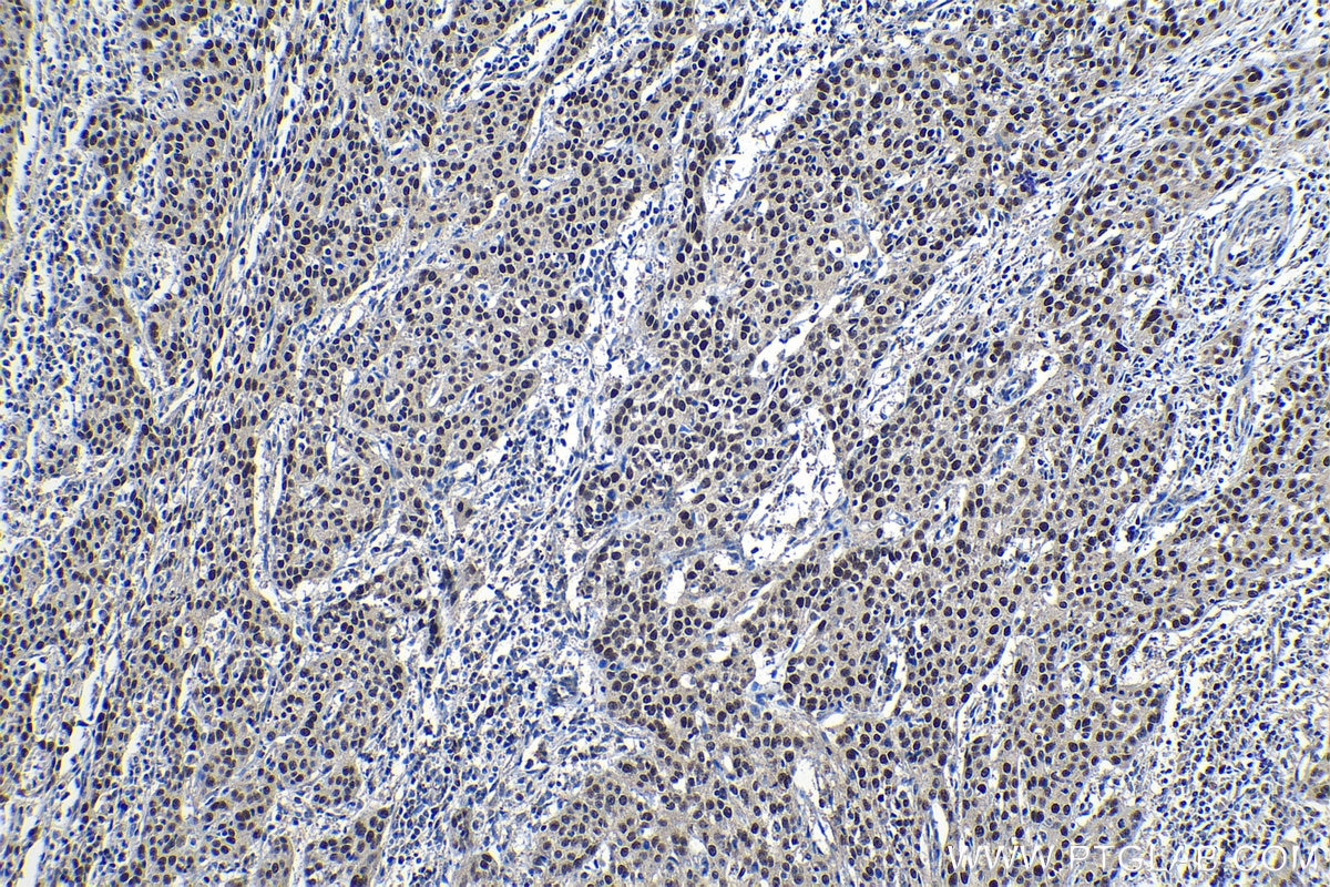 Immunohistochemistry (IHC) staining of human cervical cancer tissue using MCM2 Polyclonal antibody (10513-1-AP)