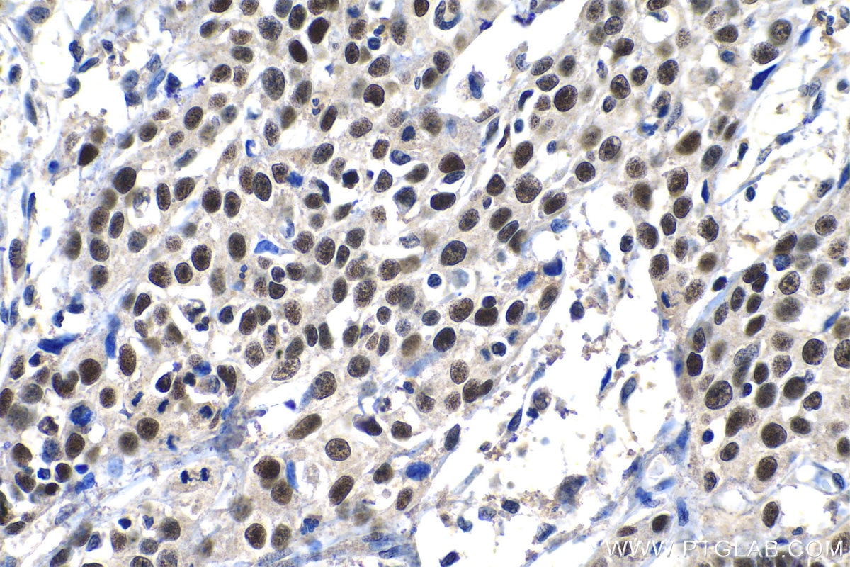 Immunohistochemistry (IHC) staining of human cervical cancer tissue using MCM2 Polyclonal antibody (10513-1-AP)