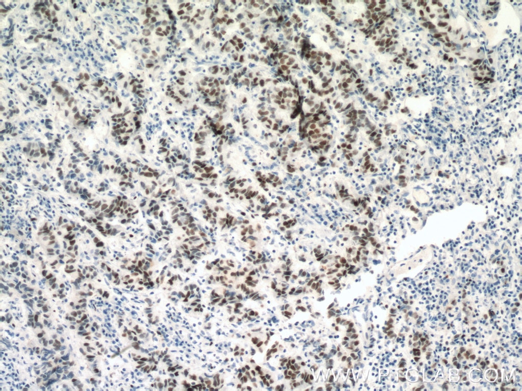 Immunohistochemistry (IHC) staining of human prostate cancer tissue using MCM2 Monoclonal antibody (66204-1-Ig)