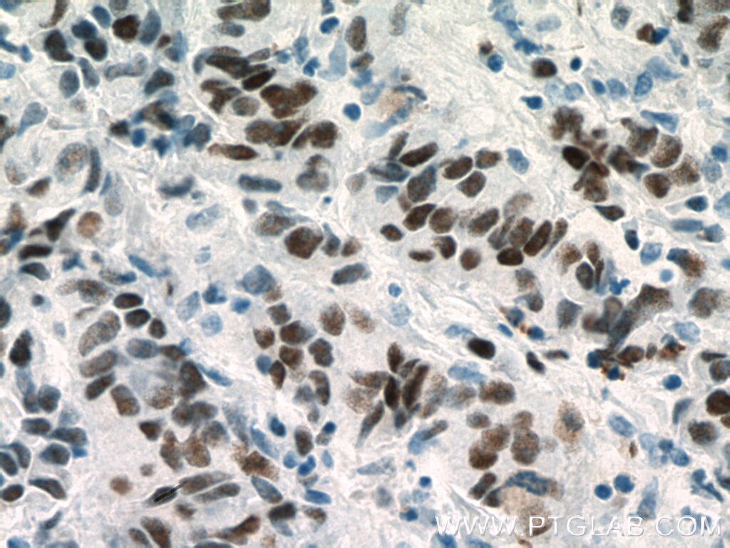 Immunohistochemistry (IHC) staining of human prostate cancer tissue using MCM2 Monoclonal antibody (66204-1-Ig)