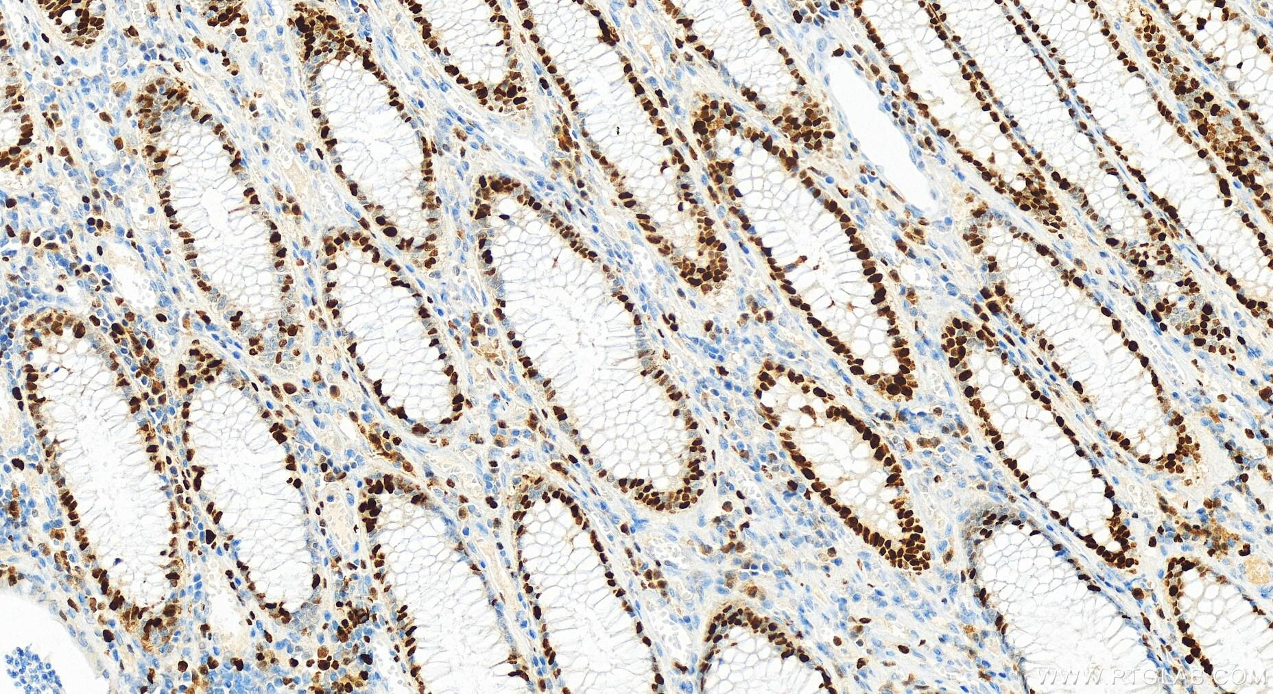 Immunohistochemistry (IHC) staining of human colon cancer tissue using MCM2 Recombinant antibody (84511-5-RR)