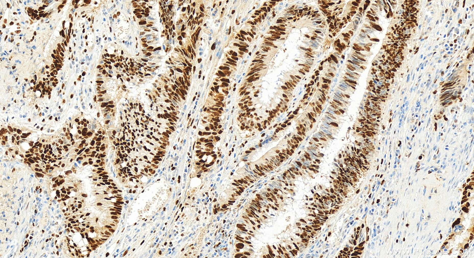 Immunohistochemistry (IHC) staining of human colon cancer tissue using MCM2 Recombinant antibody (84511-5-RR)
