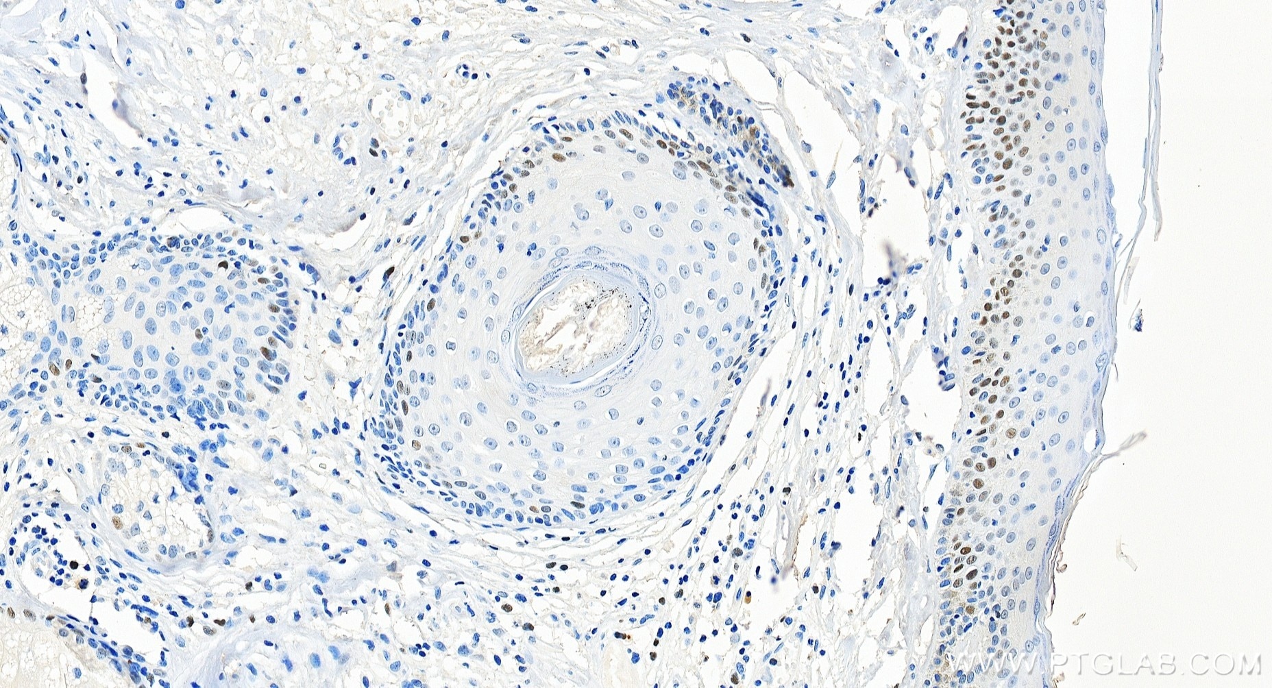 Immunohistochemical analysis of paraffin-embedded human skin tissue slide using 84511-5-RR (MCM2 antibody) at dilution of 1:2000 (under 20x lens). Heat mediated antigen retrieval with Tris-EDTA buffer (pH 9.0). Immunohistochemistry (IHC) staining of human skin tissue using MCM2 Recombinant monoclonal antibody (84511-5-RR)