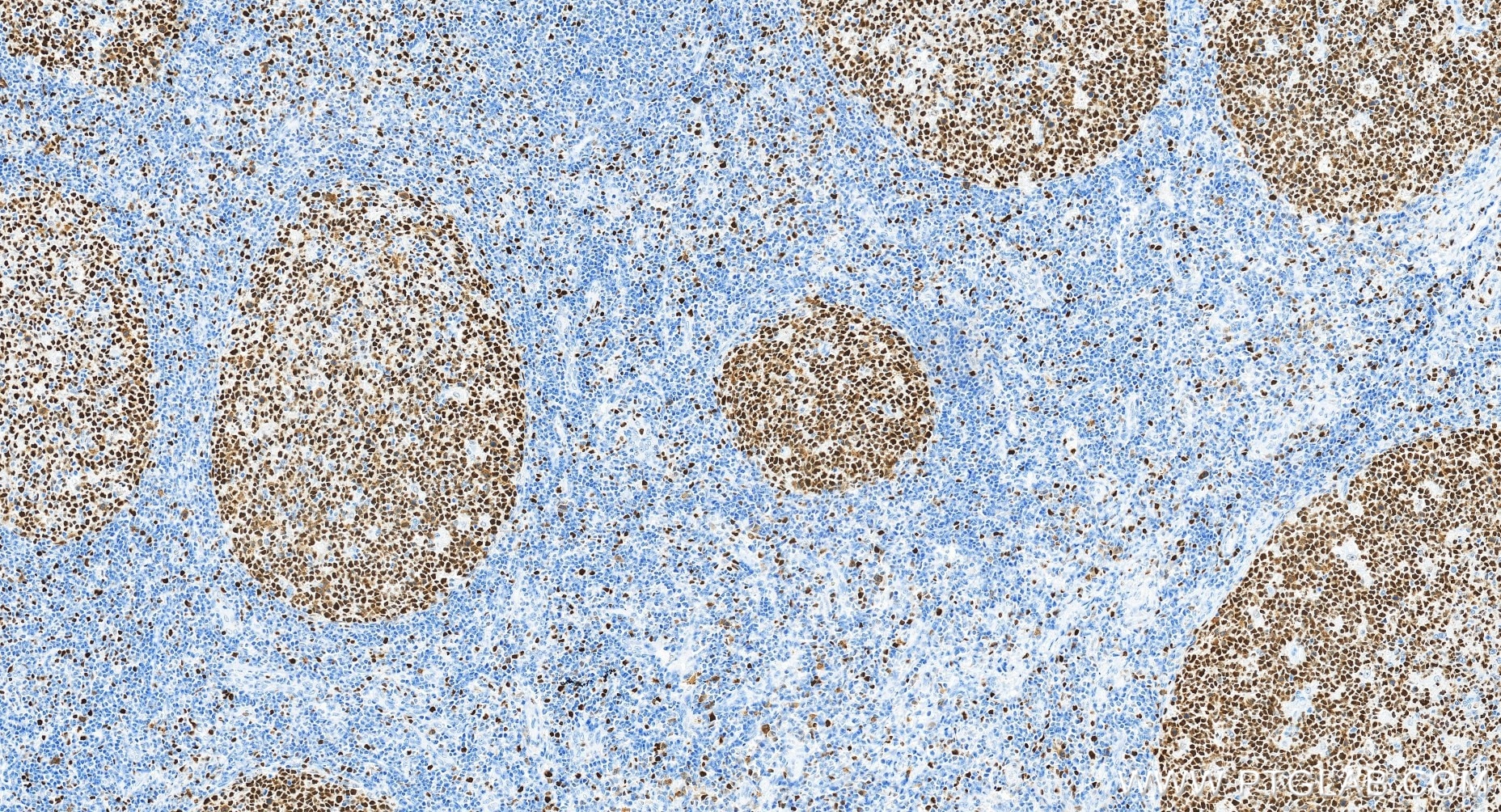 Immunohistochemical analysis of paraffin-embedded human tonsillitis tissue slide using 84511-5-RR (MCM2 antibody) at dilution of 1:2000 (under 20x lens). Heat mediated antigen retrieval with Tris-EDTA buffer (pH 9.0). Immunohistochemistry (IHC) staining of human tonsillitis tissue using MCM2 Recombinant monoclonal antibody (84511-5-RR)