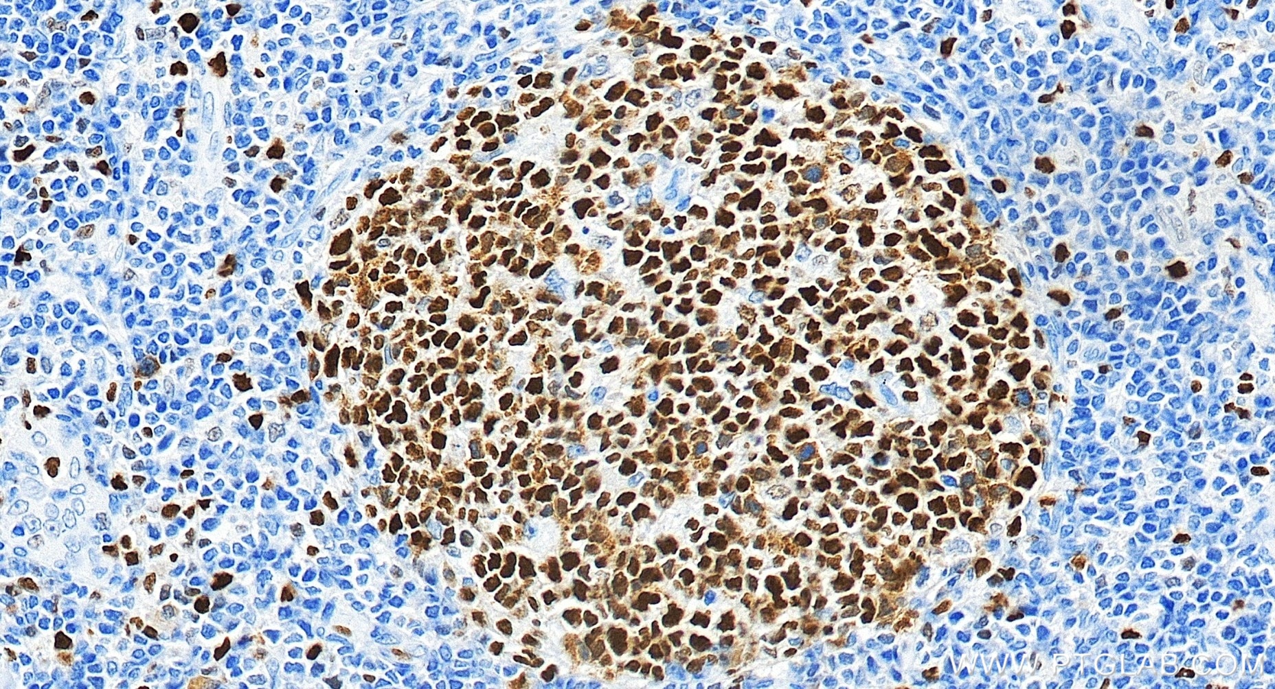 Immunohistochemical analysis of paraffin-embedded human tonsillitis tissue slide using 84511-5-RR (MCM2 antibody) at dilution of 1:2000 (under 20x lens). Heat mediated antigen retrieval with Tris-EDTA buffer (pH 9.0). Immunohistochemistry (IHC) staining of human tonsillitis tissue using MCM2 Recombinant monoclonal antibody (84511-5-RR)