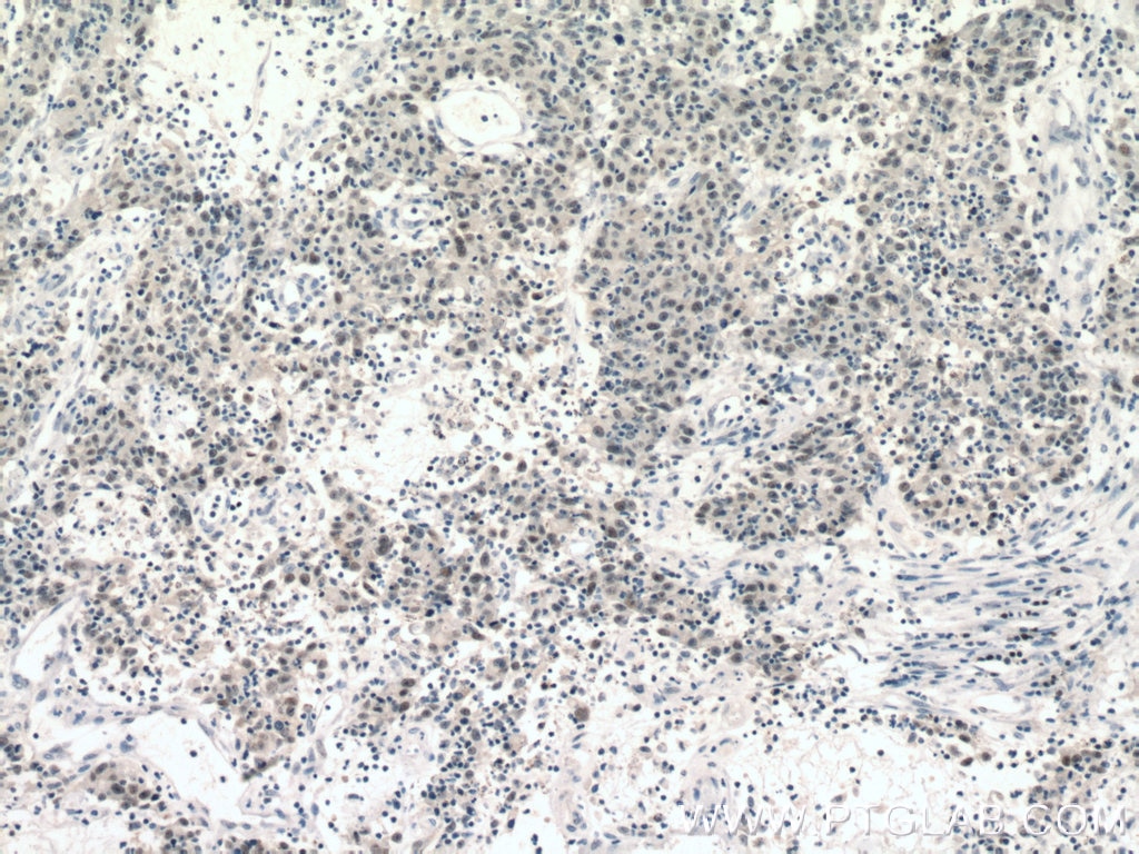 Immunohistochemistry (IHC) staining of human colon cancer tissue using MCM3 Polyclonal antibody (15597-1-AP)