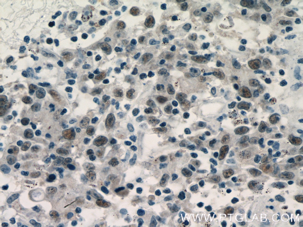 Immunohistochemistry (IHC) staining of human colon cancer tissue using MCM3 Polyclonal antibody (15597-1-AP)