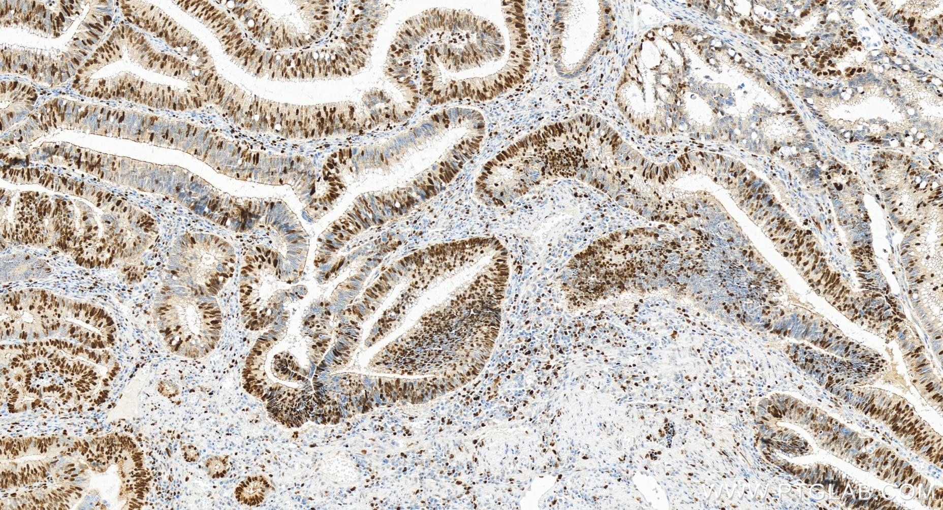 Immunohistochemistry (IHC) staining of human colon cancer tissue using MCM3 Recombinant antibody (84792-5-RR)