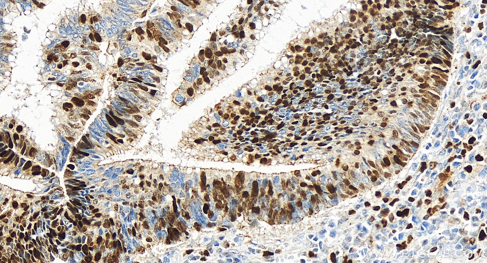 Immunohistochemistry (IHC) staining of human colon cancer tissue using MCM3 Recombinant antibody (84792-5-RR)