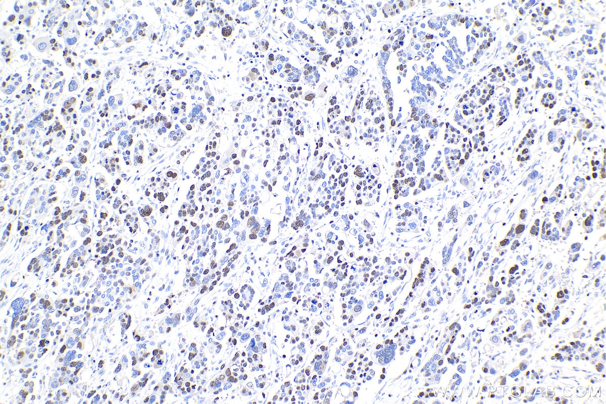 Immunohistochemistry (IHC) staining of human colon cancer tissue using MCM4 Polyclonal antibody (13043-1-AP)