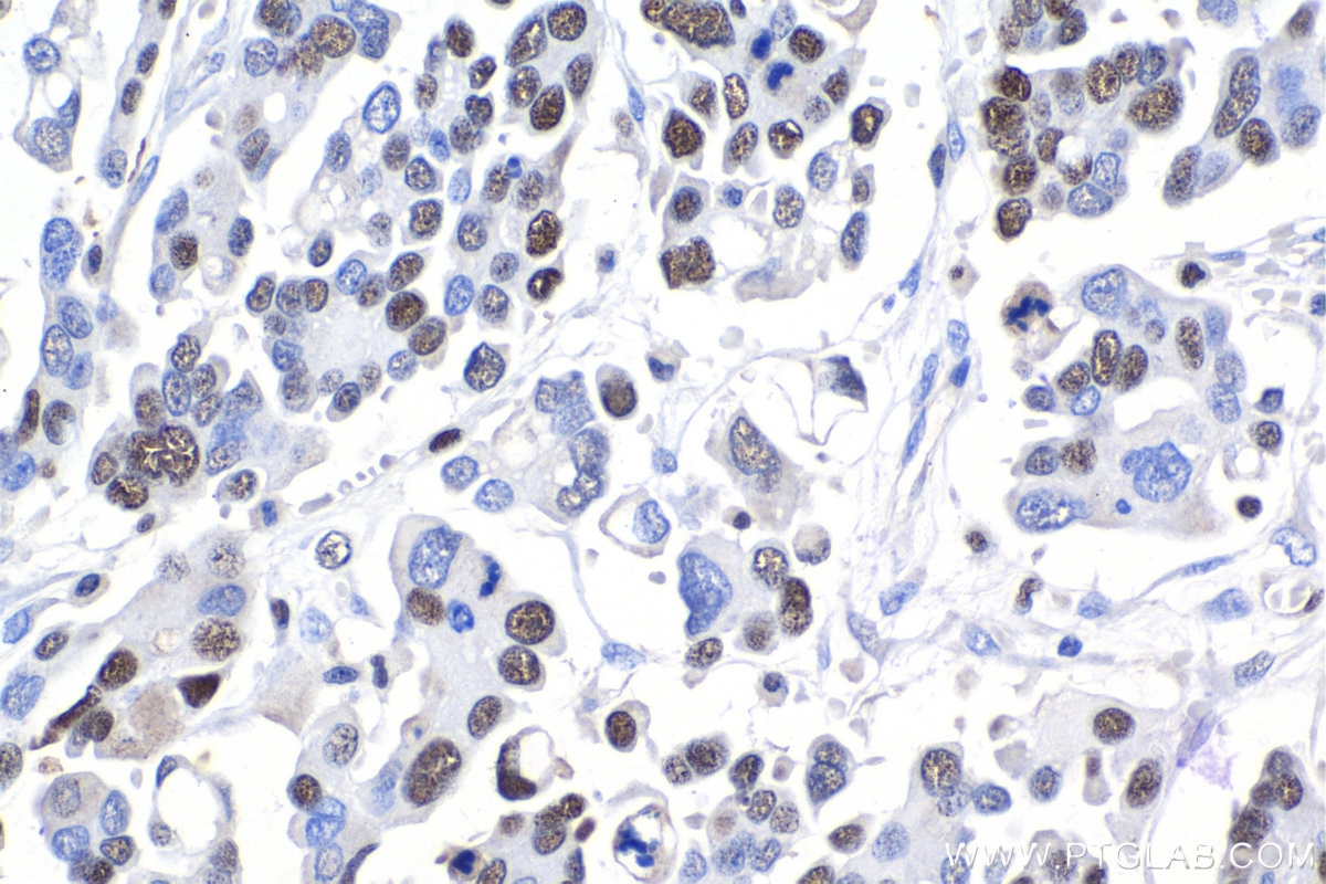 Immunohistochemistry (IHC) staining of human colon cancer tissue using MCM4 Polyclonal antibody (13043-1-AP)