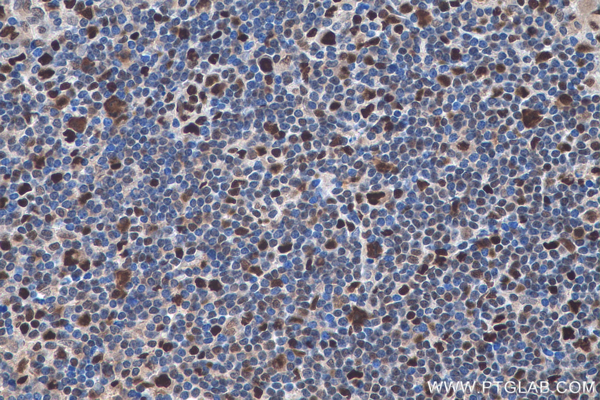 Immunohistochemistry (IHC) staining of human lymphoma tissue using MCM5 Polyclonal antibody (11703-1-AP)