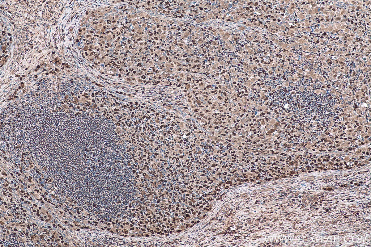 Immunohistochemistry (IHC) staining of human lymphoma tissue using MCM5 Polyclonal antibody (11703-1-AP)