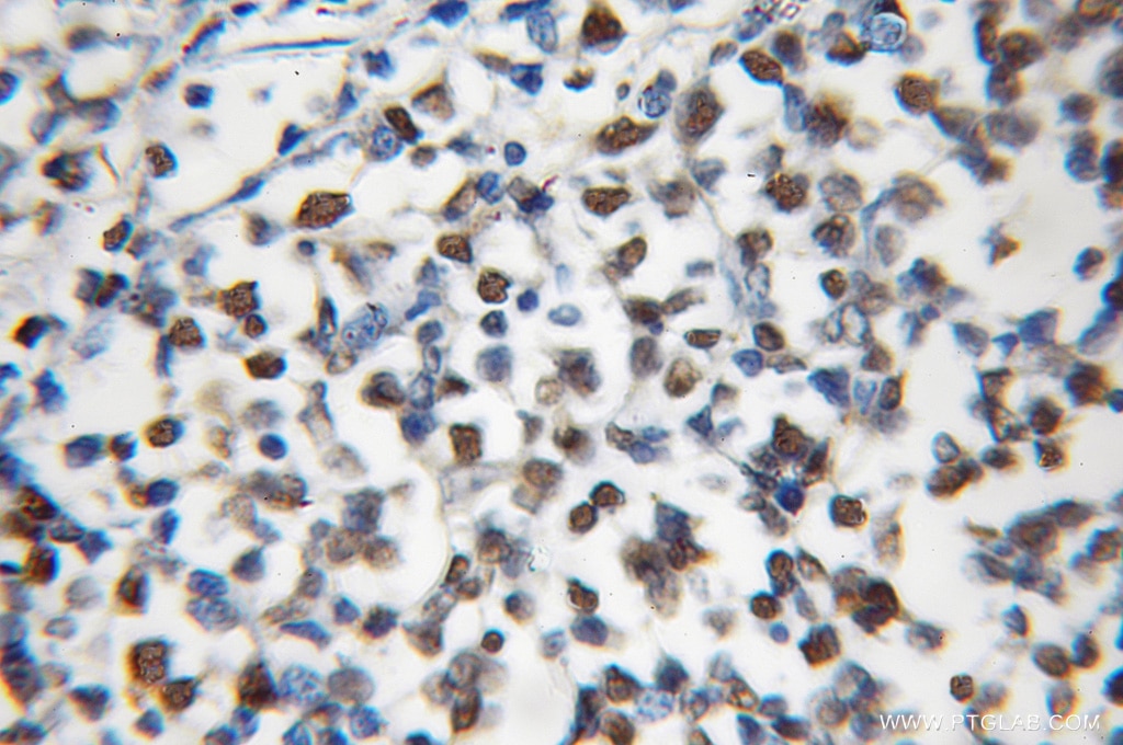 Immunohistochemistry (IHC) staining of human lymphoma tissue using MCM5 Polyclonal antibody (11703-1-AP)