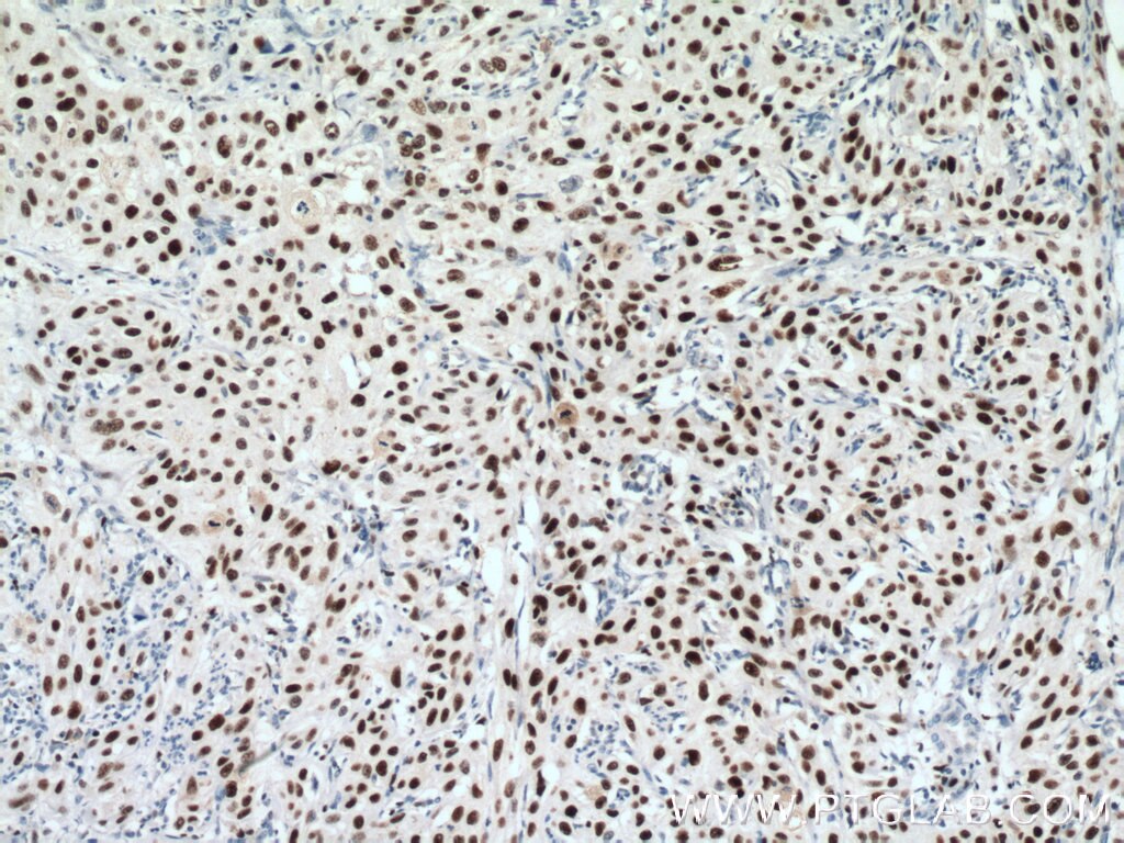 Immunohistochemistry (IHC) staining of human cervical cancer tissue using MCM6 Polyclonal antibody (13347-2-AP)