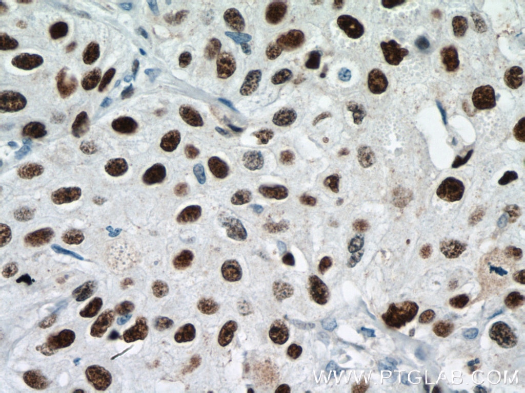 Immunohistochemistry (IHC) staining of human cervical cancer tissue using MCM6 Polyclonal antibody (13347-2-AP)
