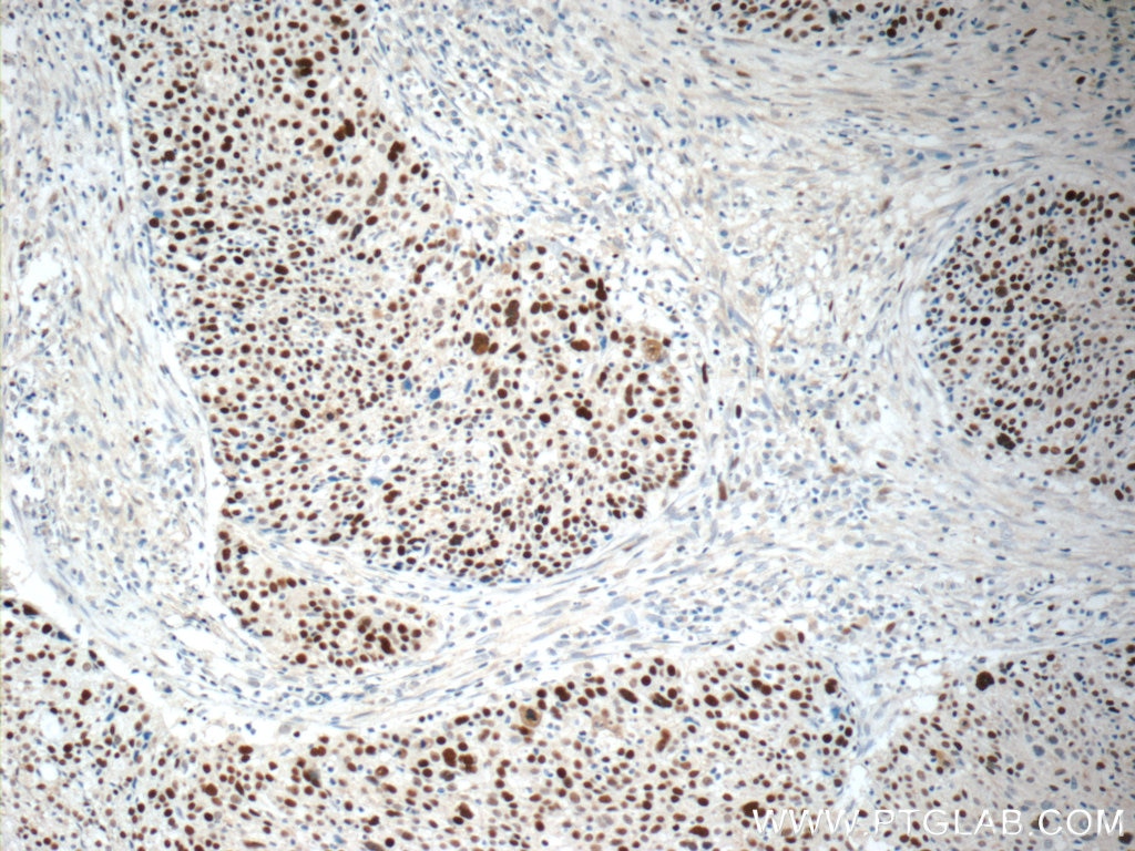 Immunohistochemistry (IHC) staining of human lung cancer tissue using MCM6 Polyclonal antibody (13347-2-AP)