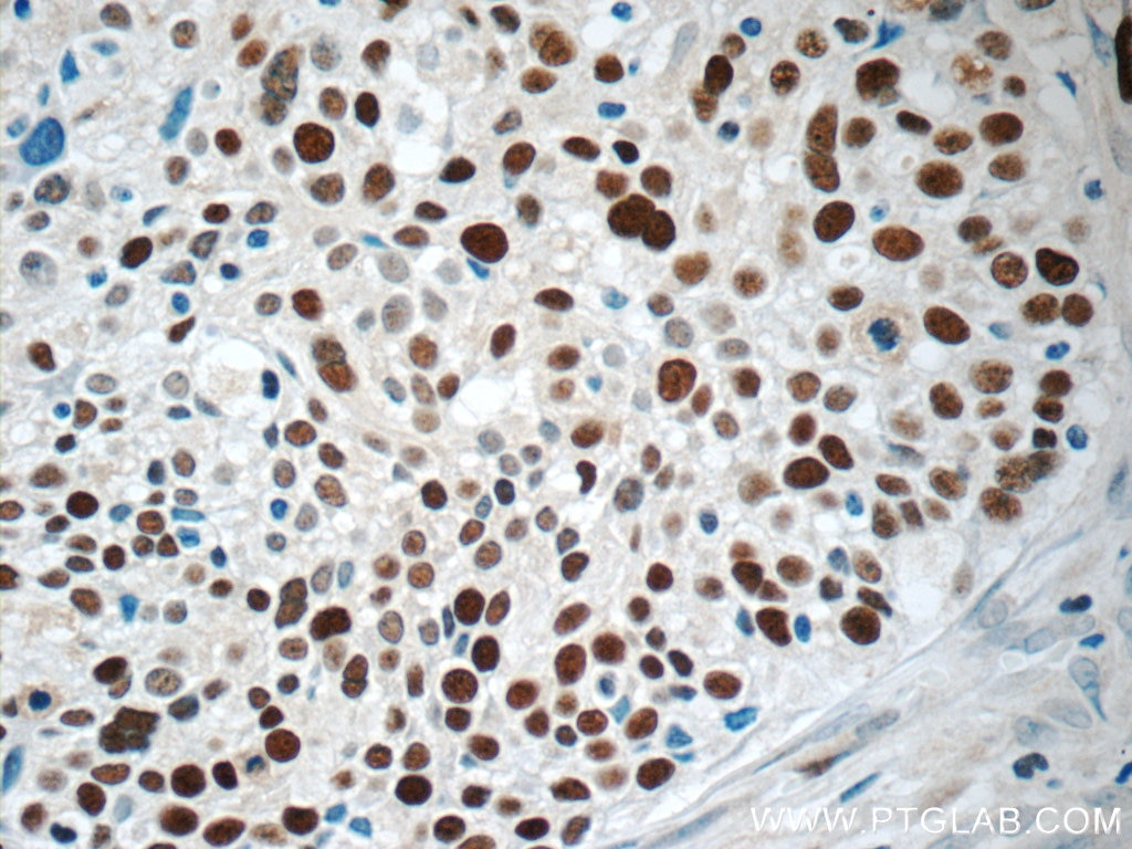 Immunohistochemistry (IHC) staining of human lung cancer tissue using MCM6 Polyclonal antibody (13347-2-AP)