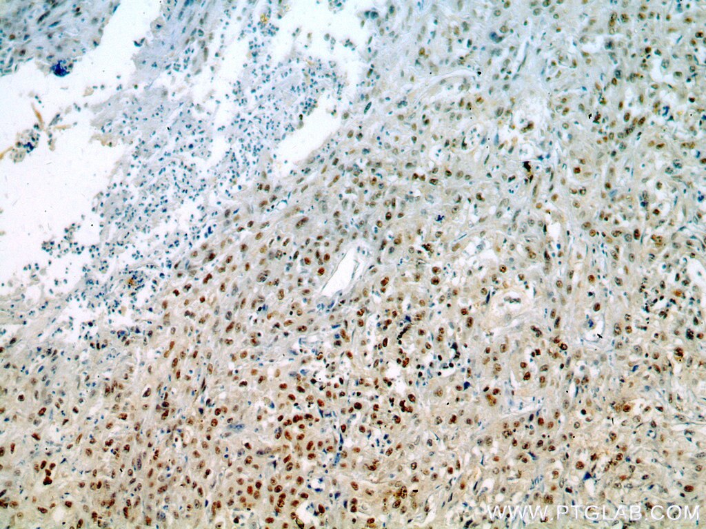 Immunohistochemistry (IHC) staining of human cervical cancer tissue using MCM6 Polyclonal antibody (13347-2-AP)