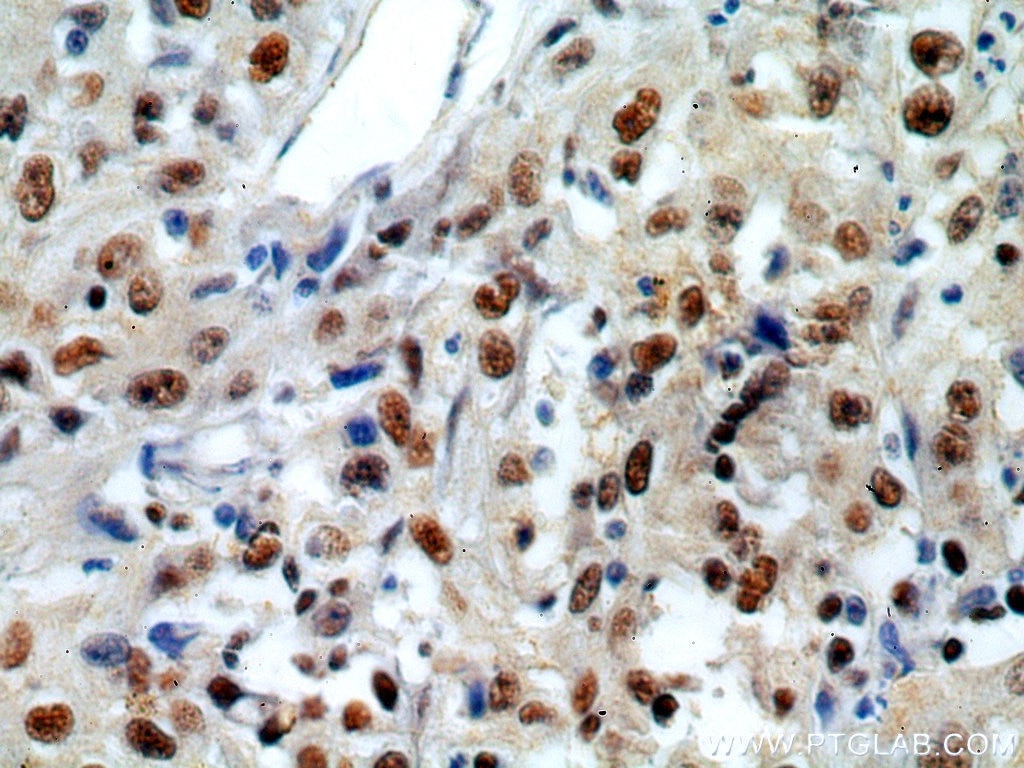 Immunohistochemistry (IHC) staining of human cervical cancer tissue using MCM6 Polyclonal antibody (13347-2-AP)