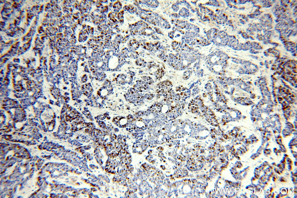 Immunohistochemistry (IHC) staining of human cervical cancer tissue using MCM6 Polyclonal antibody (13347-2-AP)