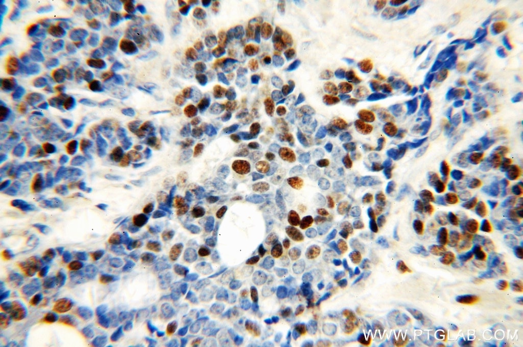 Immunohistochemistry (IHC) staining of human cervical cancer tissue using MCM6 Polyclonal antibody (13347-2-AP)