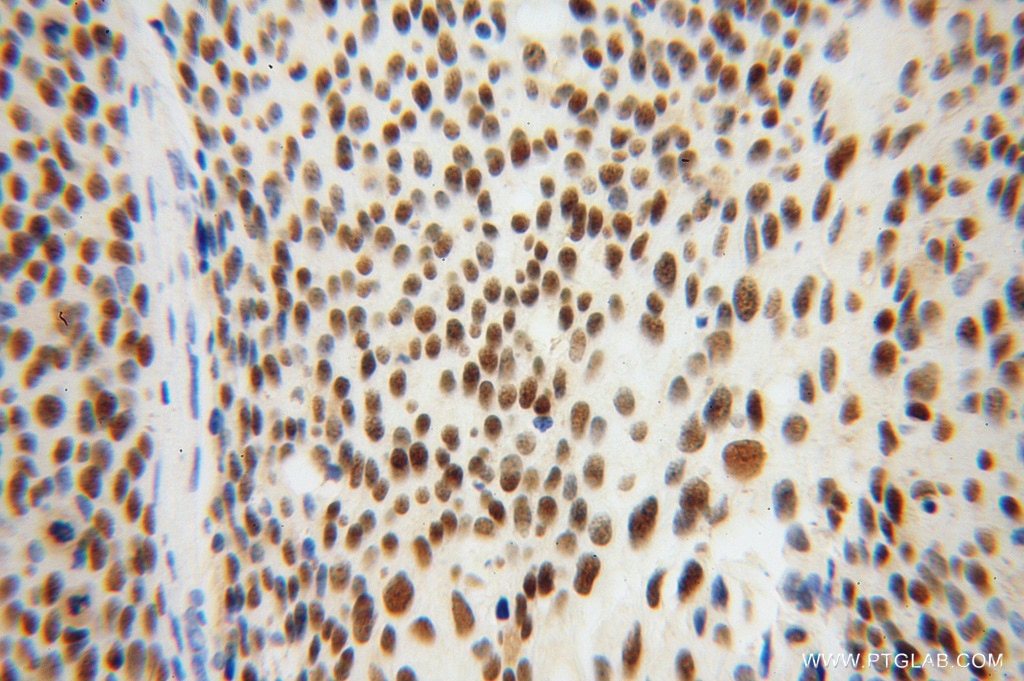 Immunohistochemistry (IHC) staining of human cervical cancer tissue using MCM6 Polyclonal antibody (13347-2-AP)