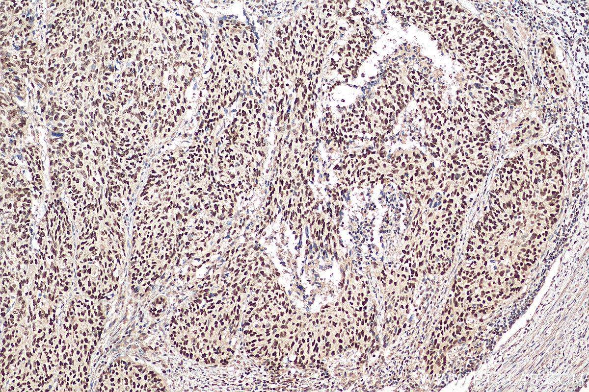 Immunohistochemistry (IHC) staining of human cervical cancer tissue using MCM6 Monoclonal antibody (67989-1-Ig)