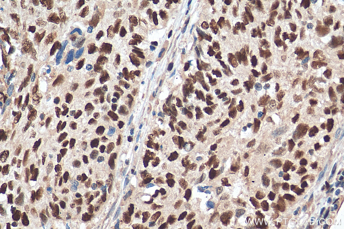 Immunohistochemistry (IHC) staining of human cervical cancer tissue using MCM6 Monoclonal antibody (67989-1-Ig)