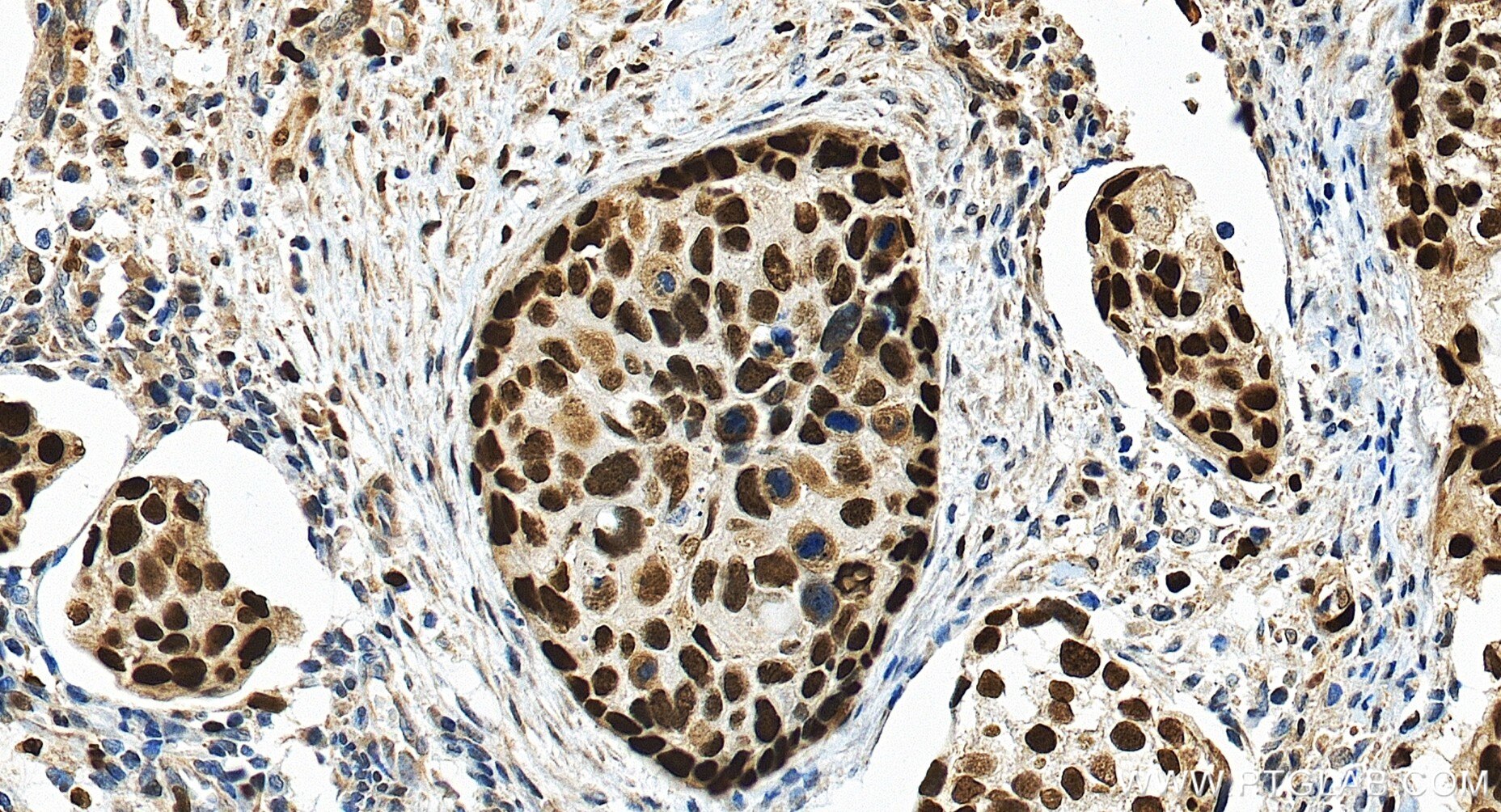 IHC staining of human cervical cancer using 86950-1-RR Immunohistochemistry (IHC) staining of human cervical cancer tissue using MCM6 Recombinant monoclonal antibody (86950-1-RR)