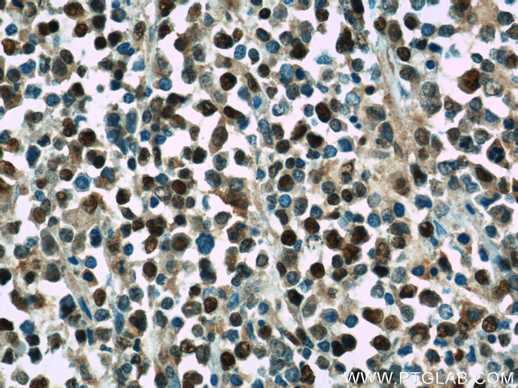 Immunohistochemistry (IHC) staining of human lymphoma tissue using MCM7 Polyclonal antibody (11225-1-AP)