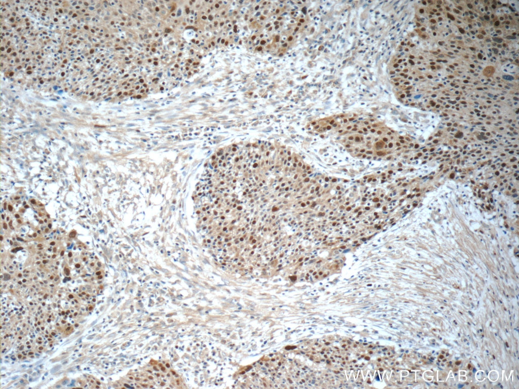 Immunohistochemistry (IHC) staining of human lung cancer tissue using MCM7 Polyclonal antibody (11225-1-AP)